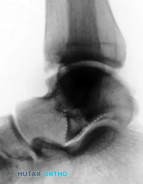 OPEN REDUCTION AND INTERNAL FIXATION OF FRACTURES OF THE LATERAL PROCESS OF THE TALUS Surgical Diagram
