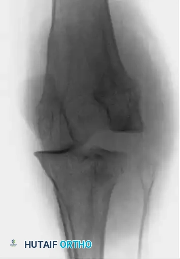 Open Reduction for Old Unreduced Knee Dislocation