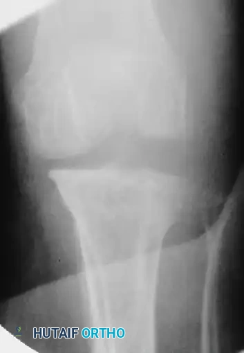 OPEN REDUCTION FOR OLD UNREDUCED DISLOCATION OF THE KNEE Surgical Diagram
