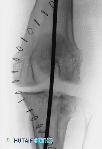 OPEN REDUCTION FOR OLD UNREDUCED DISLOCATION OF THE KNEE Surgical Diagram