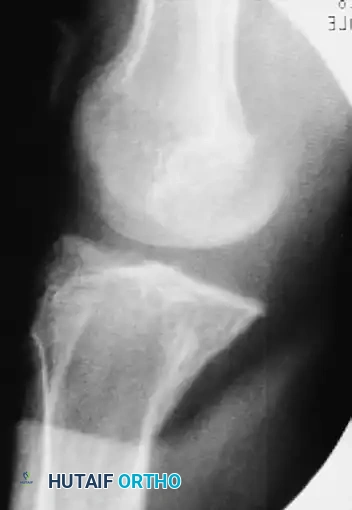 OPEN REDUCTION FOR OLD UNREDUCED DISLOCATION OF THE KNEE Surgical Diagram