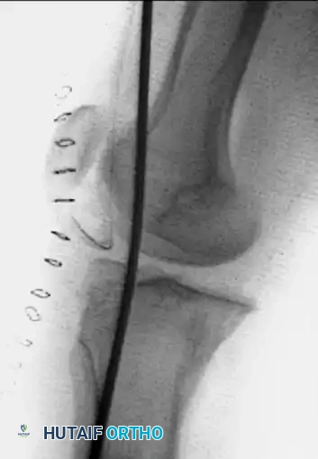 OPEN REDUCTION FOR OLD UNREDUCED DISLOCATION OF THE KNEE Surgical Diagram