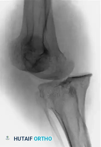 OPEN REDUCTION FOR OLD UNREDUCED DISLOCATION OF THE KNEE Surgical Diagram