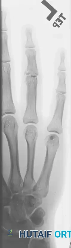 OPEN REDUCTION— NONCOMMINUTED Surgical Diagram