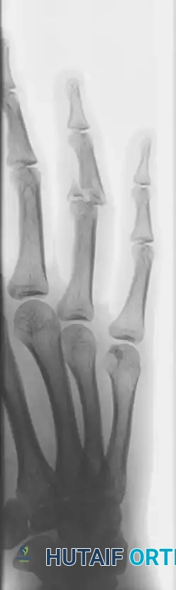 Mastering Open Reduction and Internal Fixation of Noncomminuted Proximal Interphalangeal Joint Fracture-Dislocations