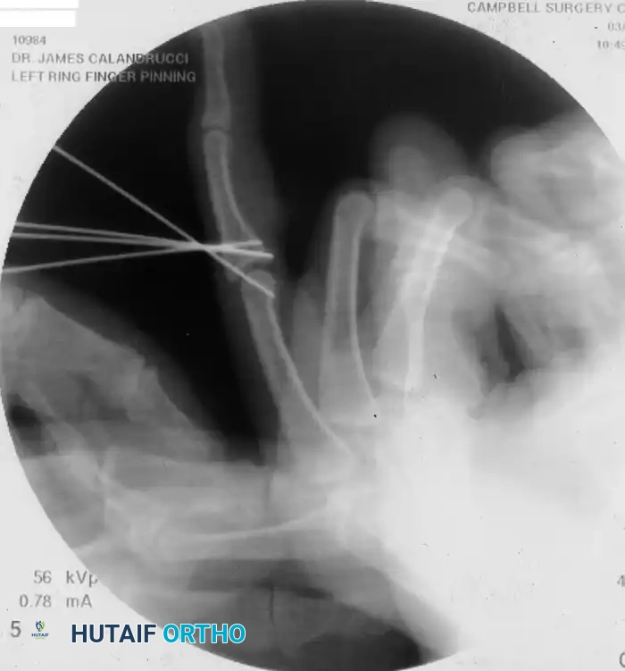 OPEN REDUCTION— NONCOMMINUTED Surgical Diagram