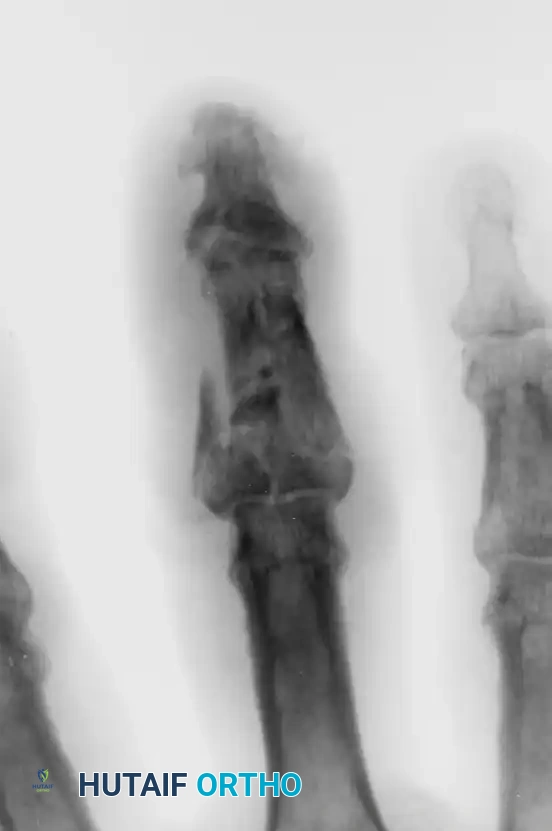 OPEN REDUCTION— NONCOMMINUTED Surgical Diagram