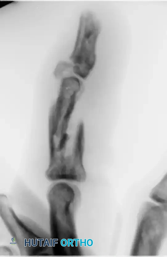 OPEN REDUCTION— NONCOMMINUTED Surgical Diagram