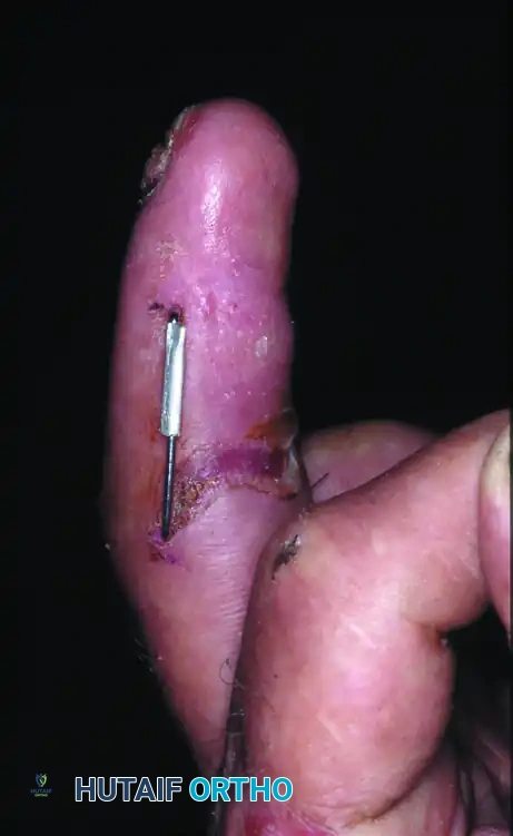 OPEN REDUCTION— NONCOMMINUTED Surgical Diagram