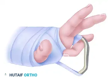 OPEN REDUCTION— NONCOMMINUTED Surgical Diagram