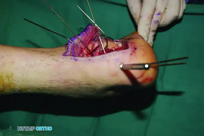 OPEN REDUCTION OF CALCANEAL FRACTURE Surgical Diagram