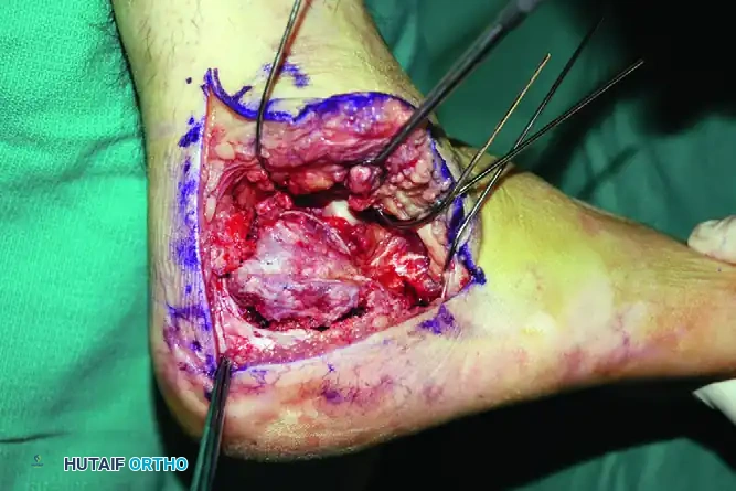 OPEN REDUCTION OF CALCANEAL FRACTURE Surgical Diagram