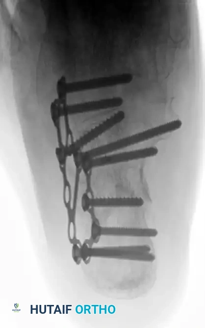 OPEN REDUCTION OF CALCANEAL FRACTURE Surgical Diagram