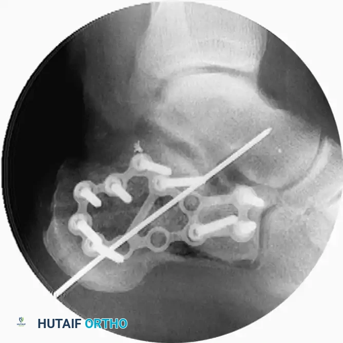 OPEN REDUCTION OF CALCANEAL FRACTURE Surgical Diagram