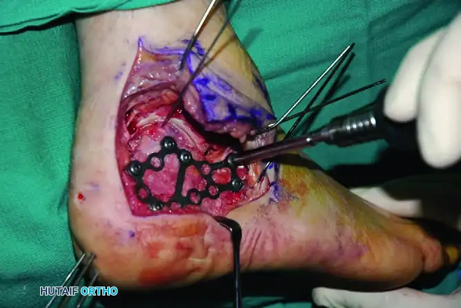 OPEN REDUCTION OF CALCANEAL FRACTURE Surgical Diagram