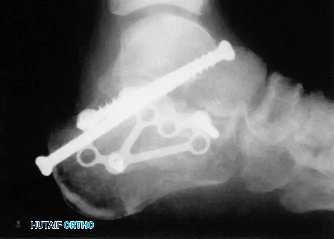 OPEN REDUCTION OF CALCANEAL FRACTURE Surgical Diagram