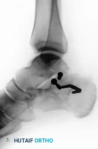 OPEN REDUCTION OF CALCANEAL FRACTURE: MEDIAL AND LATERAL APPROACHES Surgical Diagram