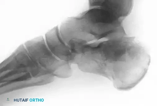 OPEN REDUCTION OF CALCANEAL FRACTURE: MEDIAL AND LATERAL APPROACHES Surgical Diagram