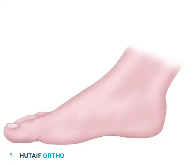 OPEN REDUCTION OF CALCANEAL FRACTURE: MEDIAL AND LATERAL APPROACHES Surgical Diagram