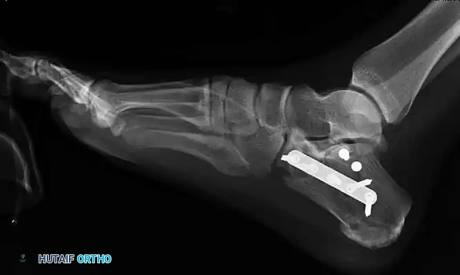 OPEN REDUCTION OF CALCANEAL FRACTURE: MEDIAL AND LATERAL APPROACHES Surgical Diagram
