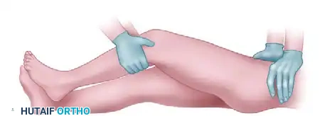 OPEN REDUCTION OF HIP DISLOCATION Surgical Diagram