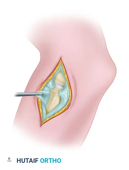 Open Reduction of Radial Head & DRUJ Dislocation