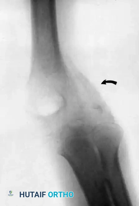 FIGURE 61-26 Anterior and lateral views of representative pin placements for old elbow dislocation.
