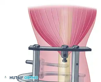 Reconstruction Step 7