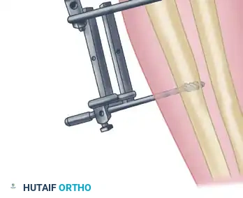 Reconstruction Step 10