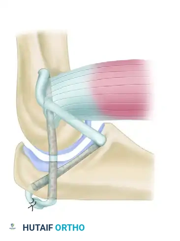 OPEN REDUCTION Surgical Diagram A