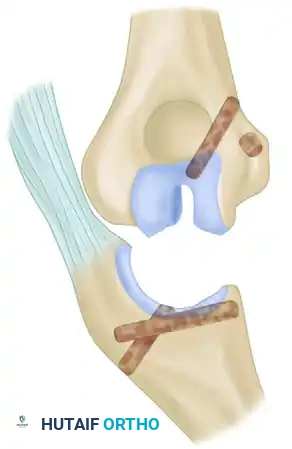 OPEN REDUCTION Surgical Diagram B