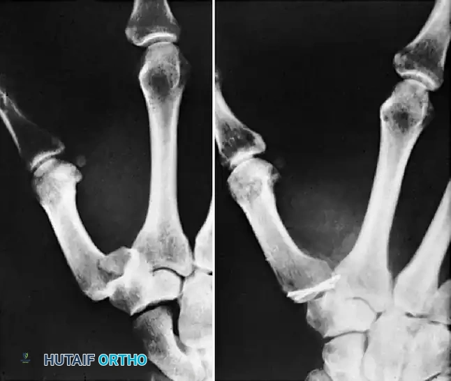 Open Reduction and Internal Fixation of Bennett Fractures