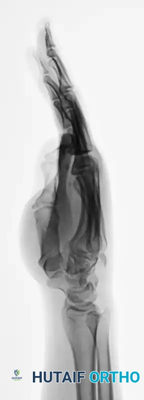 OPEN REDUCTION Surgical Diagram