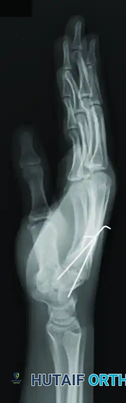 OPEN REDUCTION Surgical Diagram