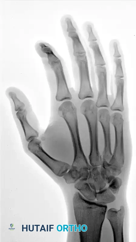 OPEN REDUCTION Surgical Diagram