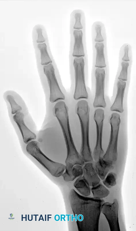 OPEN REDUCTION Surgical Diagram