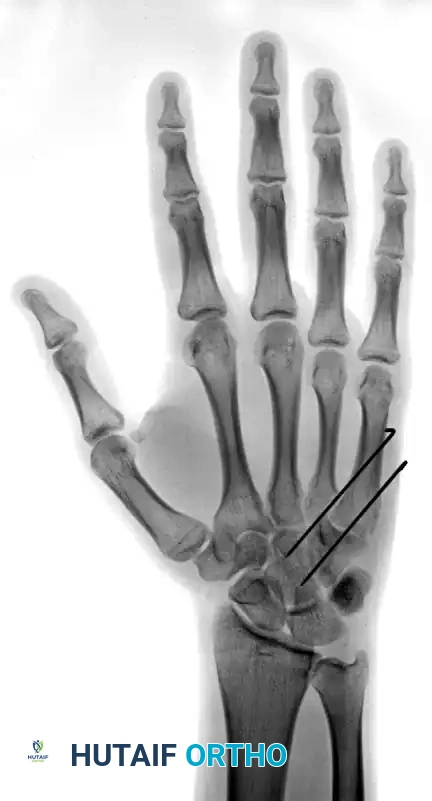 OPEN REDUCTION Surgical Diagram