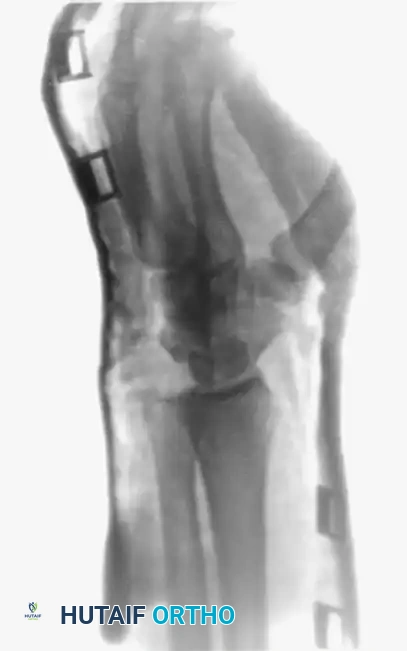 OPEN REDUCTION Surgical Diagram
