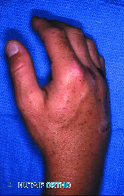 OPEN REDUCTION Surgical Diagram