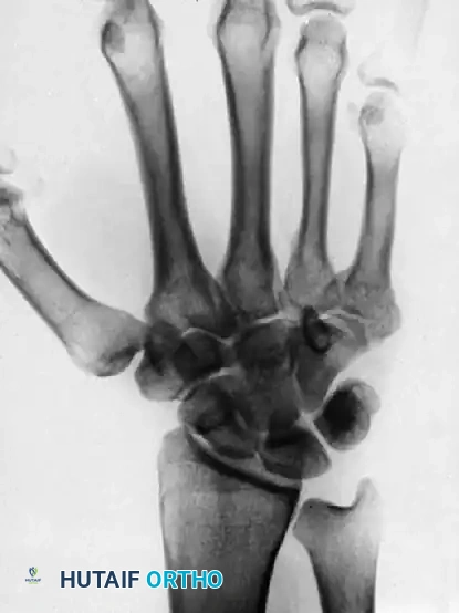 OPEN REDUCTION Surgical Diagram
