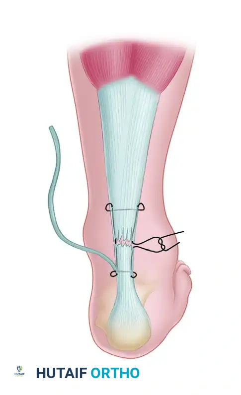 Plantaris tendon