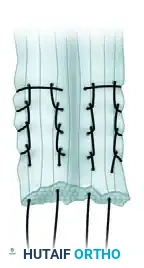 FIGURE 48-16 Lindholm technique for repairing ruptures of Achilles tendon. SEE TECHNIQUE 48-9.