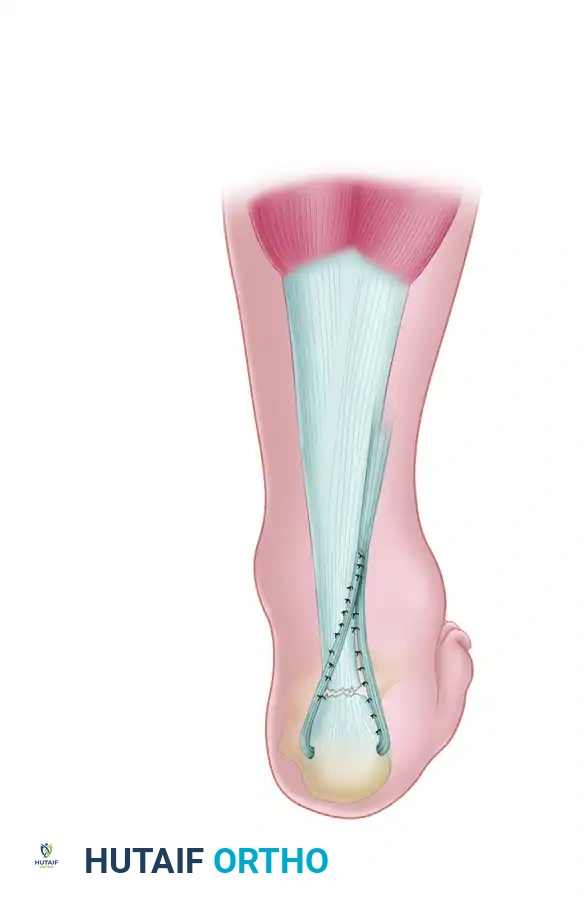 Achilles tendon Peroneus brevis