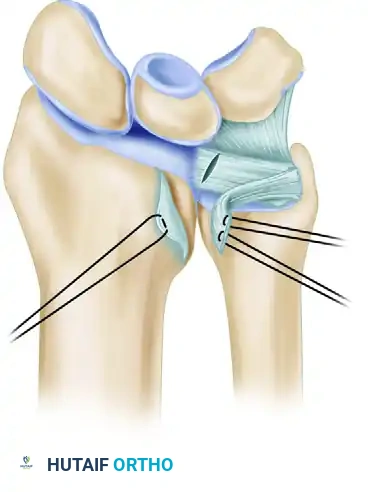 Open Repair of Class 1D TFCC Injuries: Comprehensive Surgical Guide