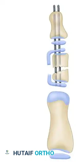 OPENING WEDGE OSTEOTOMY OF THE TERMINAL PHALANX Surgical Diagram