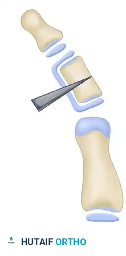 OPENING WEDGE OSTEOTOMY OF THE TERMINAL PHALANX Surgical Diagram