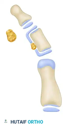 OPENING WEDGE OSTEOTOMY OF THE TERMINAL PHALANX Surgical Diagram