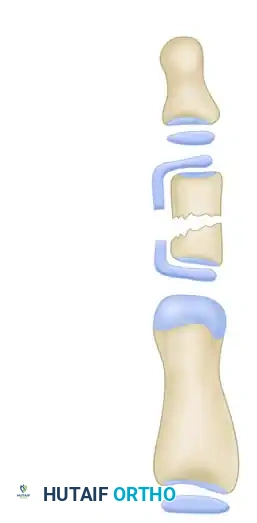 Opening Wedge Osteotomy and Surgical Management of the Delta Phalanx
