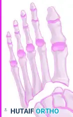 FIGURE 88-63 Cross section of foot showing release of four fascial compartments of forefoot.