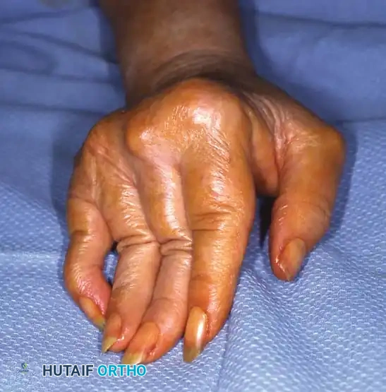 Operative Management of Hand Arthritis: Osteoarthritis, Rheumatoid Arthritis, and SLE